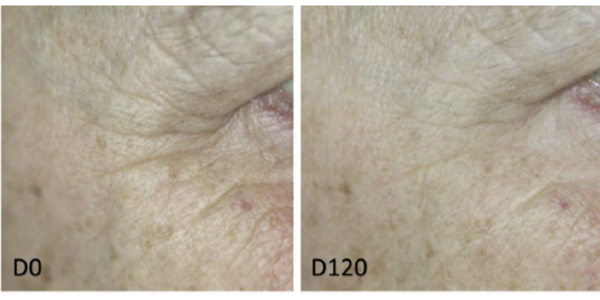 NCTF® + Exion Fractional RF / Potenza RF Microneedling®: Chanel X Combo